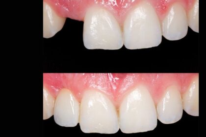 Before and After Bridge Dental